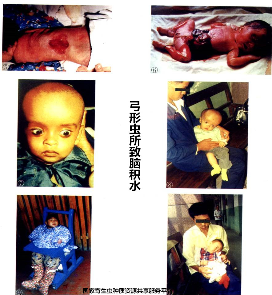22-2弓形虫所致脑积水.jpg