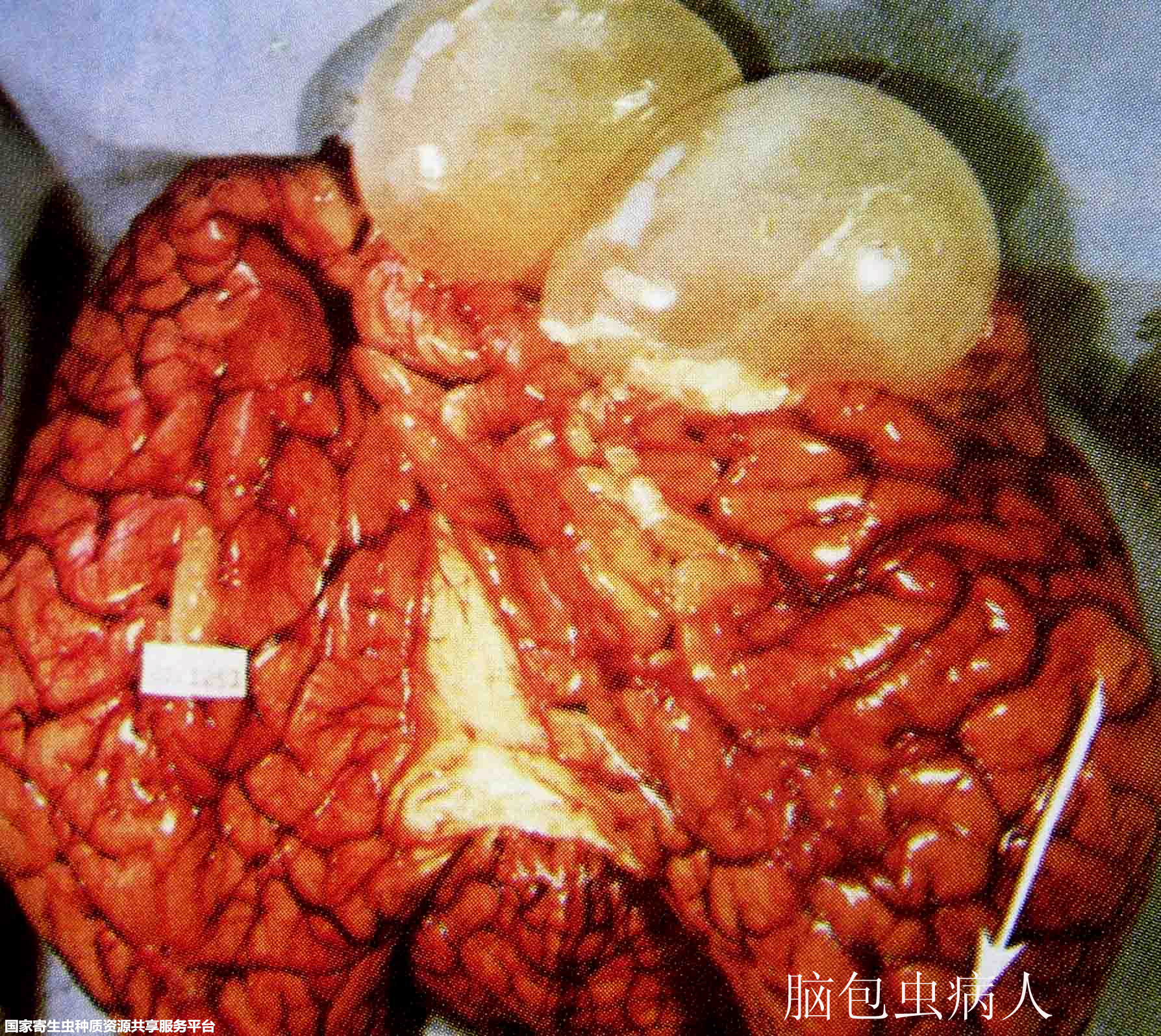 脑包虫手术图片
